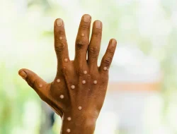 Cacar Monyet Menyebar di ASEAN, DPR: Pertimbangkan Skrining Penumpang dari Negara Terdampak